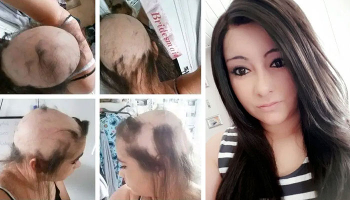 woman claims her toxic relationship gave her alopecia