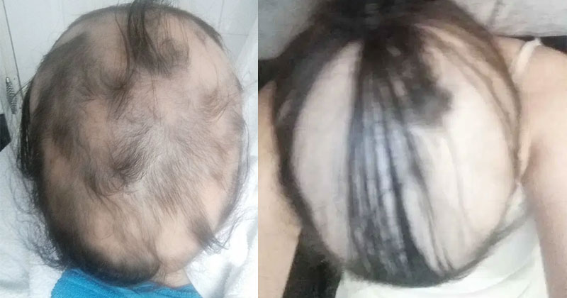 woman claims her toxic relationship gave her alopecia