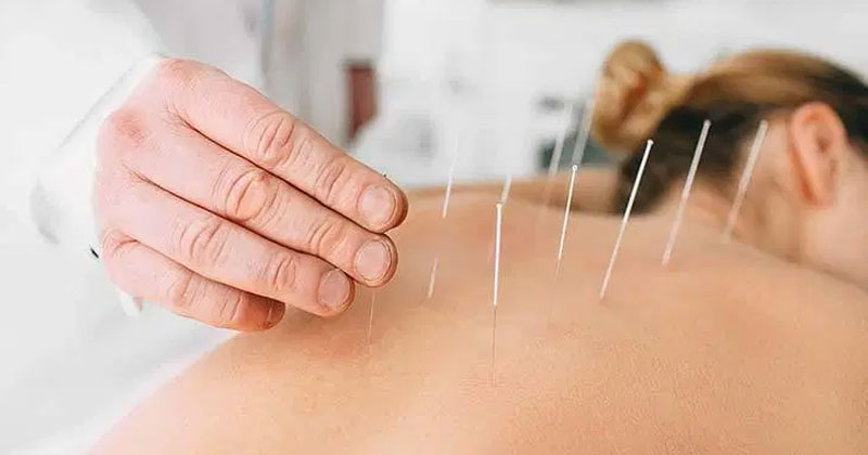 acupuncture therapy in hindi