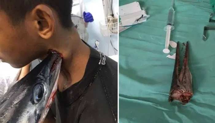 Indonesian boy stabbed neck needlefish