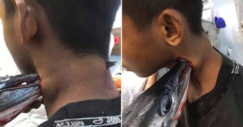 Indonesian boy stabbed neck needlefish