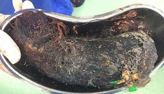 half kg human hair and empty shampoo packets removed from girl stomach