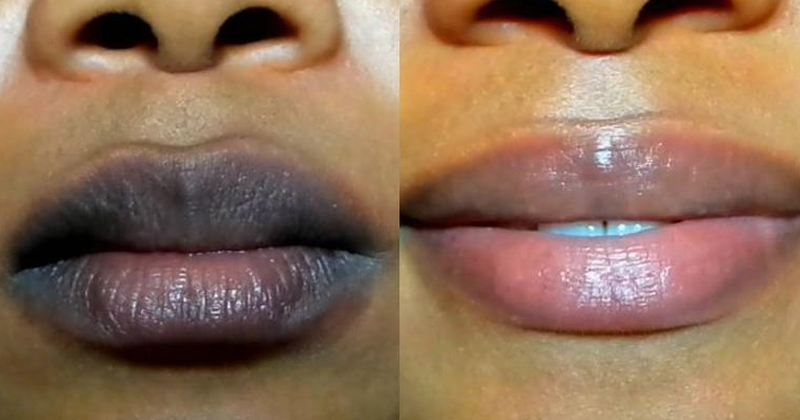 Dark Lips Treatment
