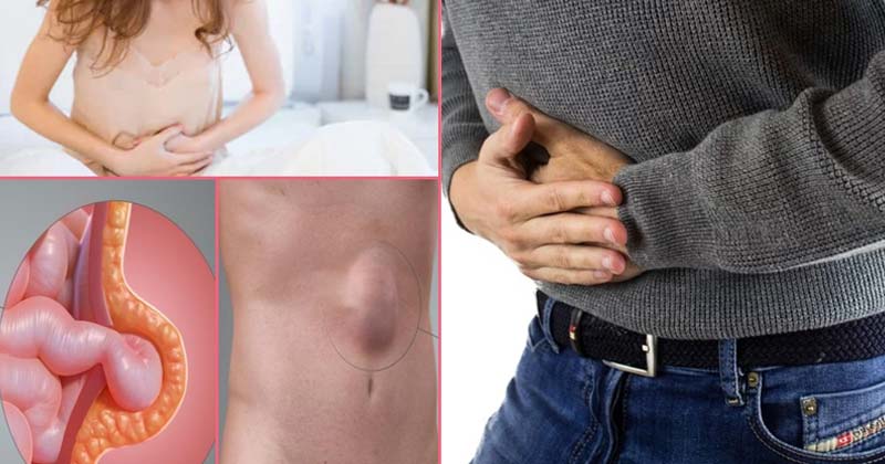 What Is Hernia In Hindi
