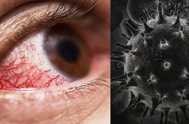 Black Fungal Infection Symptoms In Hindi