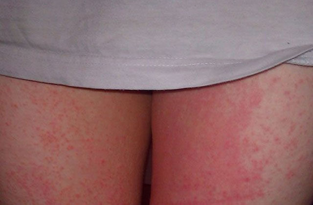 thigh rashes home remedies
