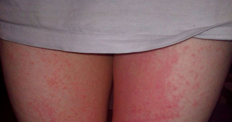 thigh rashes home remedies
