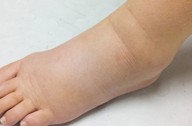 Water Retention Ke Karan Lakshan Gharelu Ilaj In Hindi