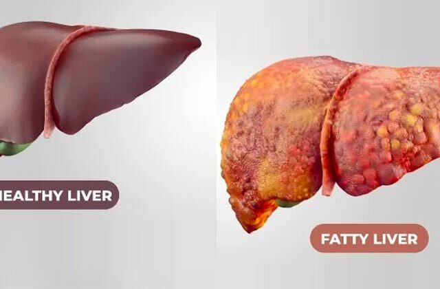 fatty liver ke lakshan karan aur upay
