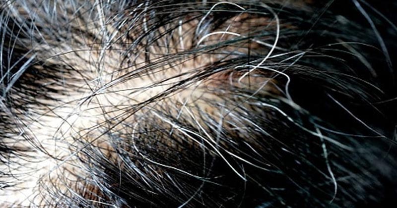 Home Remedies For White Hair In Hindi