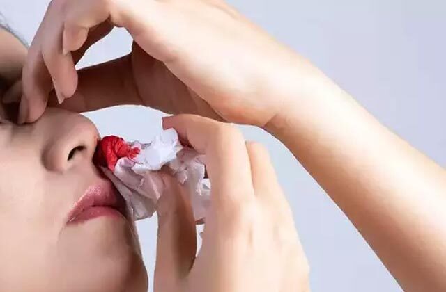 Nose Bleed Fever Ke Lakshan