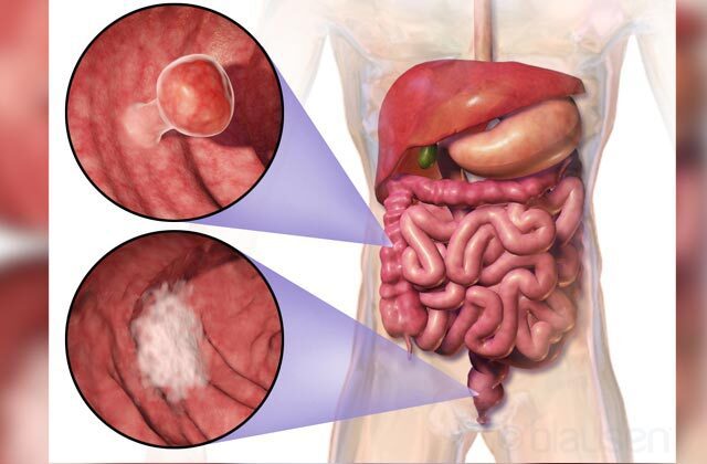 Rectal Cancer Treatment In Hindi