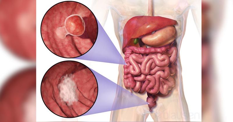 Rectal Cancer Treatment In Hindi