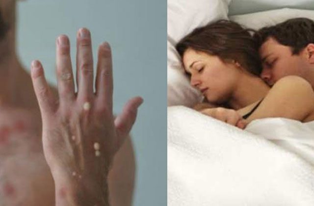 Monkeypox Is Not a Sexually Transmitted Infection In Hindi