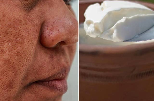 Pigmentation Hatane Ke Gharelu Upay